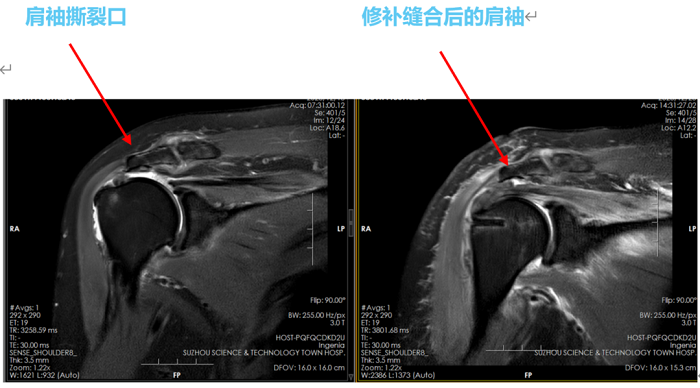 我院成功实施“Chinese Way”手术 破解不可修复巨大肩袖撕裂难题.png