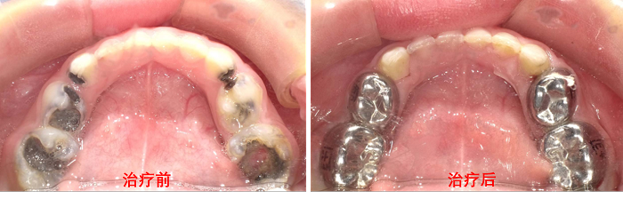5岁孩子全口乳磨牙全蛀！专家提醒：定期口腔检查很重要.png
